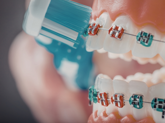 تقويم الأسنان