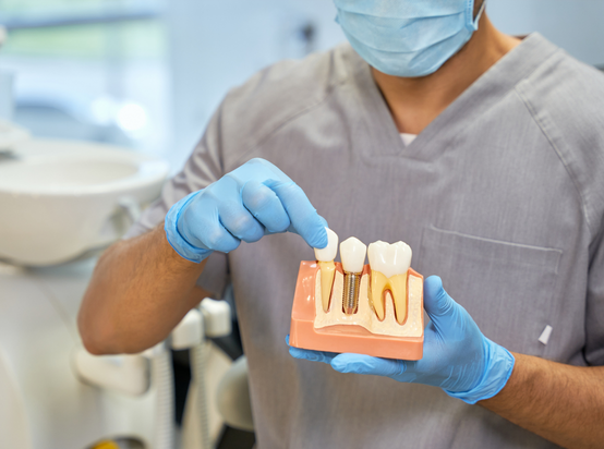 زراعة الأسنان